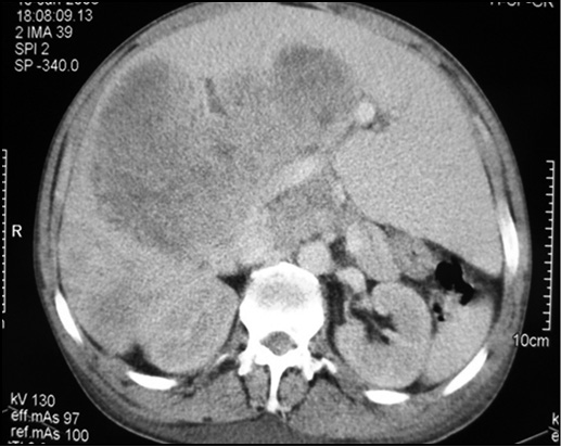 Tumormaligno1.jpg